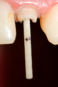 Dental treatment - fibreglass post
